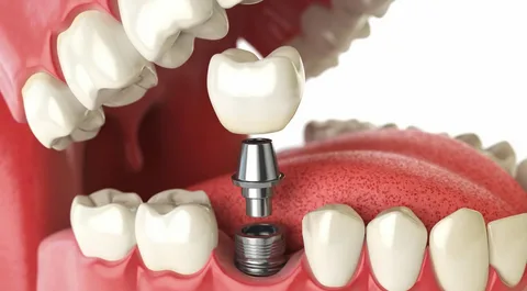 dental implants in aurangabad