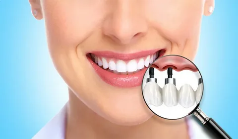 dental implants cost in badlapur